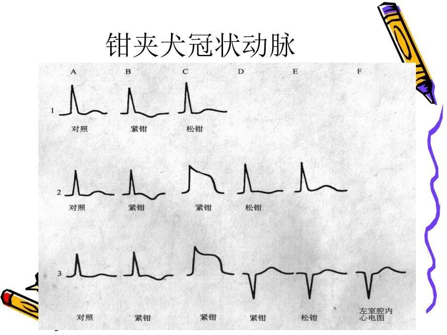急性冠脉综合征的心电图_第5页