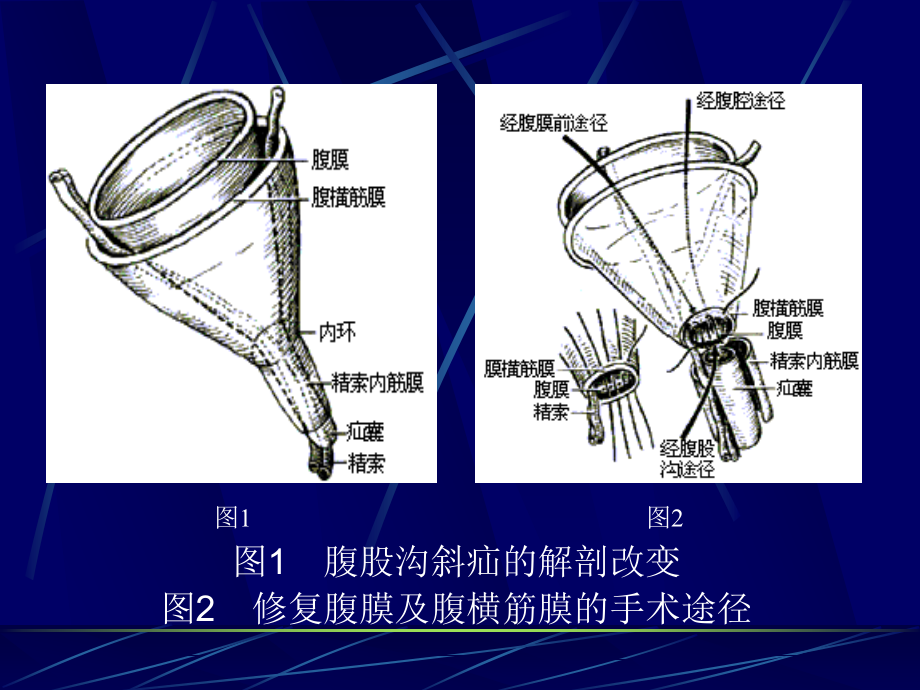 腹股沟斜疝讲诉_第2页