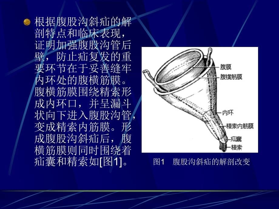 腹股沟斜疝讲诉_第5页