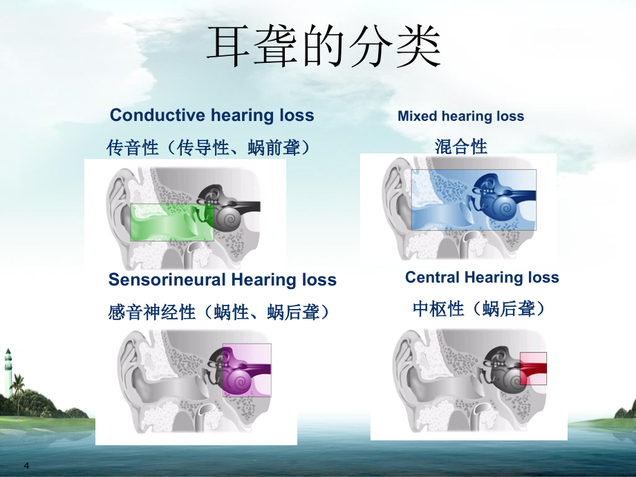 业务学习耳聋的分类及突发性耳聋护理及高压氧治疗-ppt课件_第4页