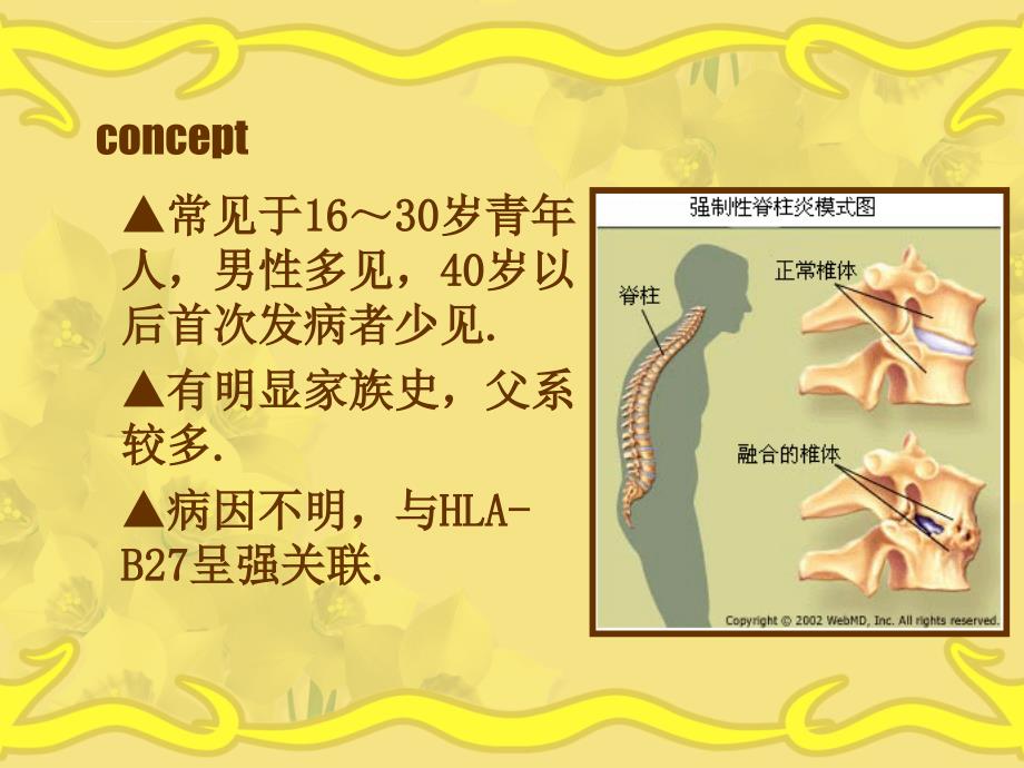 强直性脊柱炎1详解课件_第3页