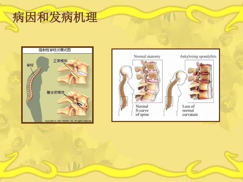 强直性脊柱炎1详解课件_第5页