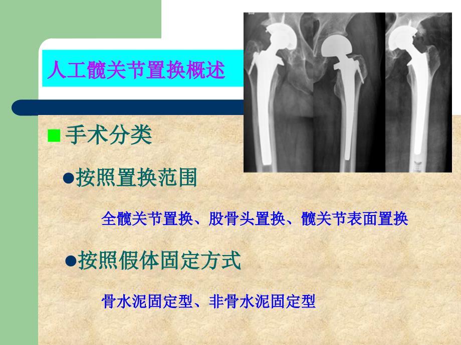 人工髋关节手术配合1课件_第4页