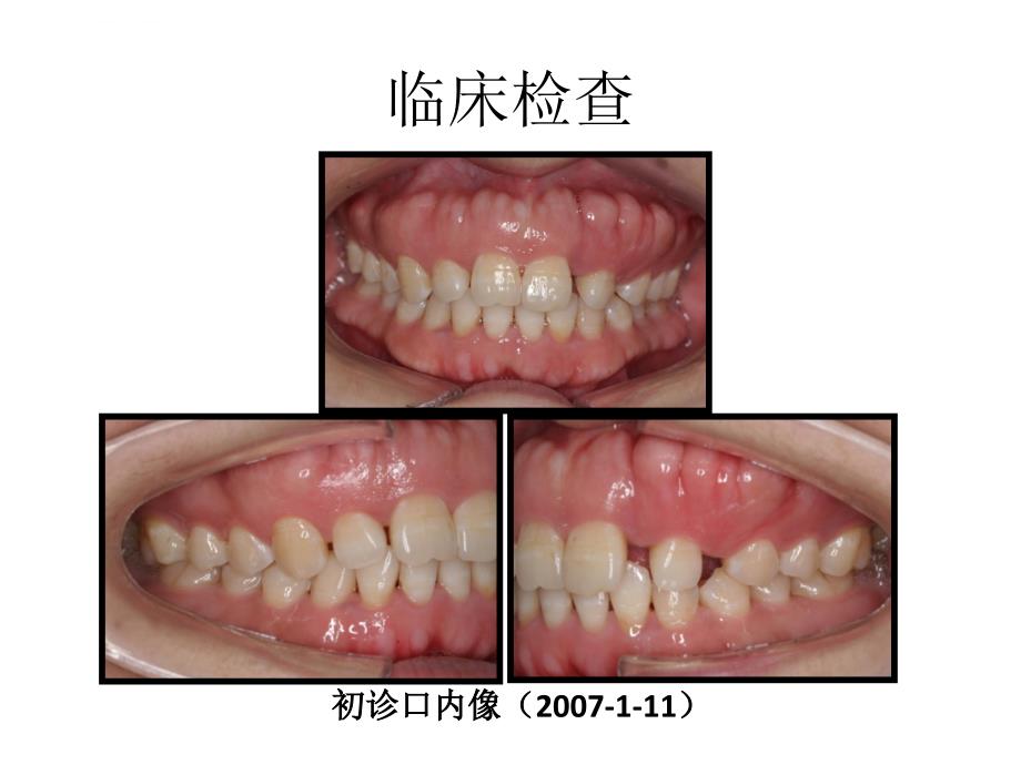 牙周基础治疗的临床病例介绍4课件_第1页