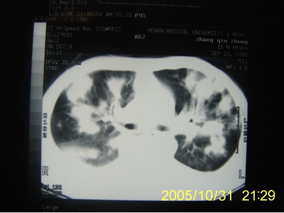 免疫功能低下患者肺部感染的诊治策略王静课件_第4页