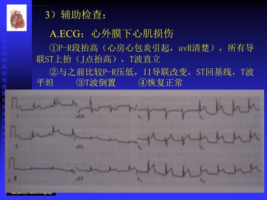 心包疾病的诊断与治疗简化课件_第5页