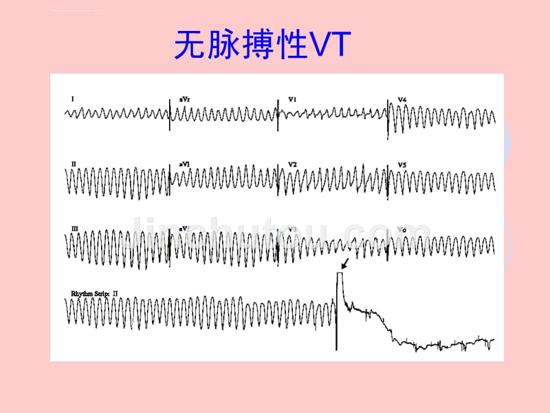 识别心肺复苏cpr课件_第5页