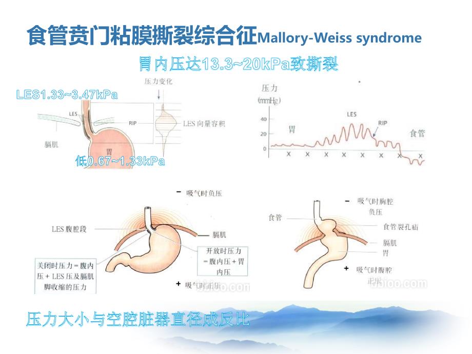 上消化道出血少见病因lcc_第3页