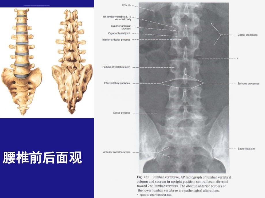 腰椎病幻灯片_第5页