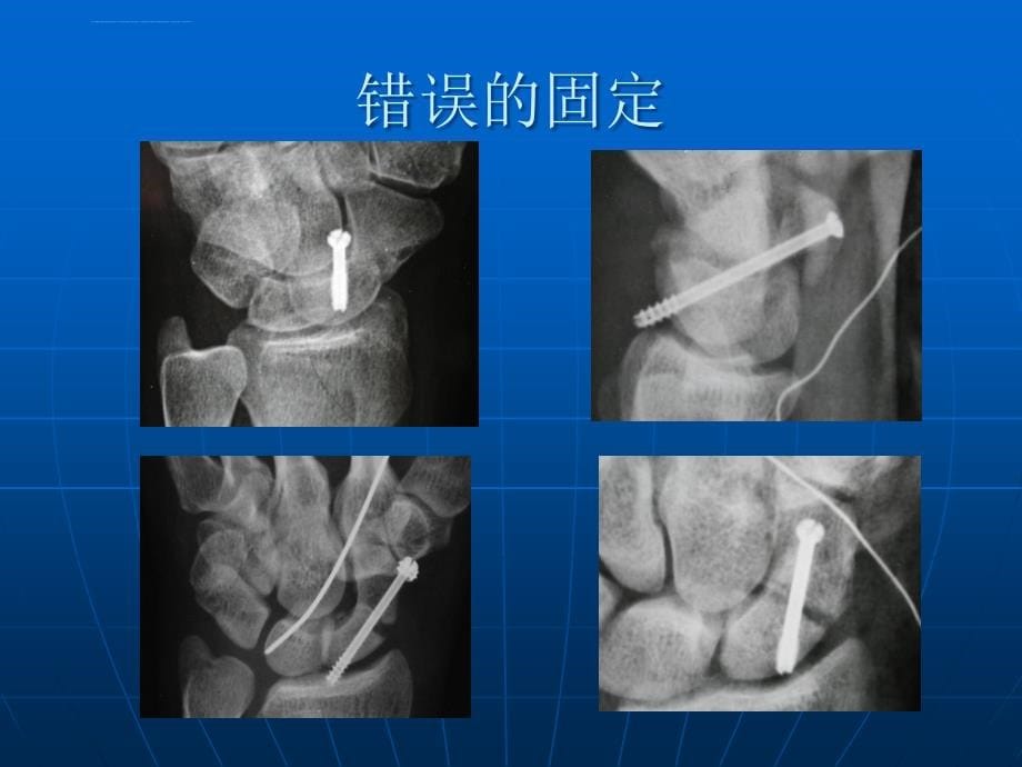 《舟骨骨折》ppt幻灯片_第5页