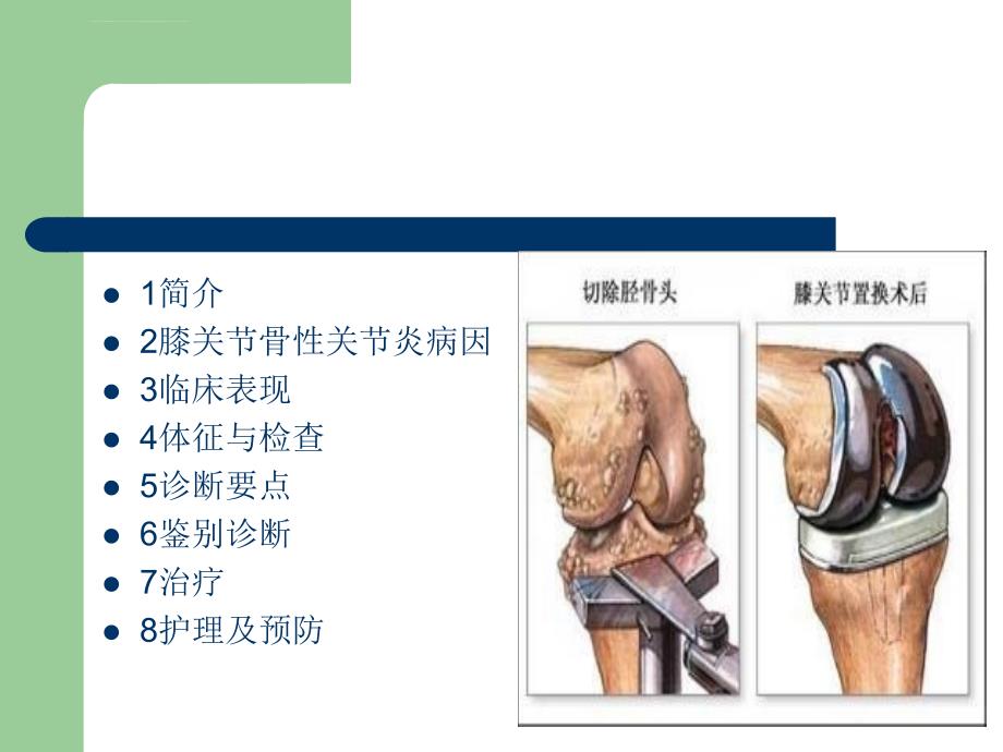 重度骨性膝关节炎..课件_第3页