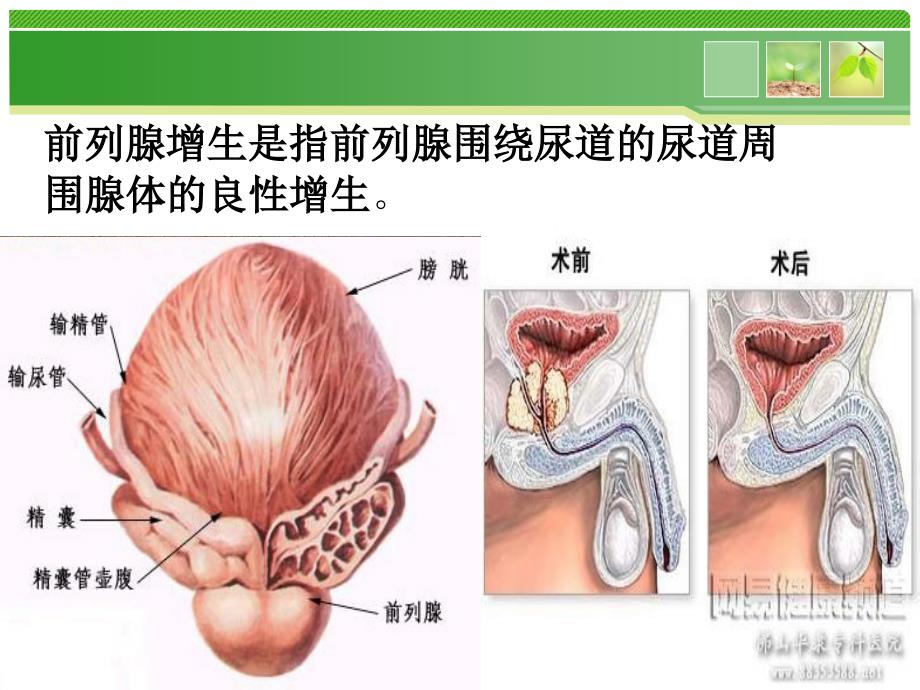 前列腺围手术期护理分析_第3页