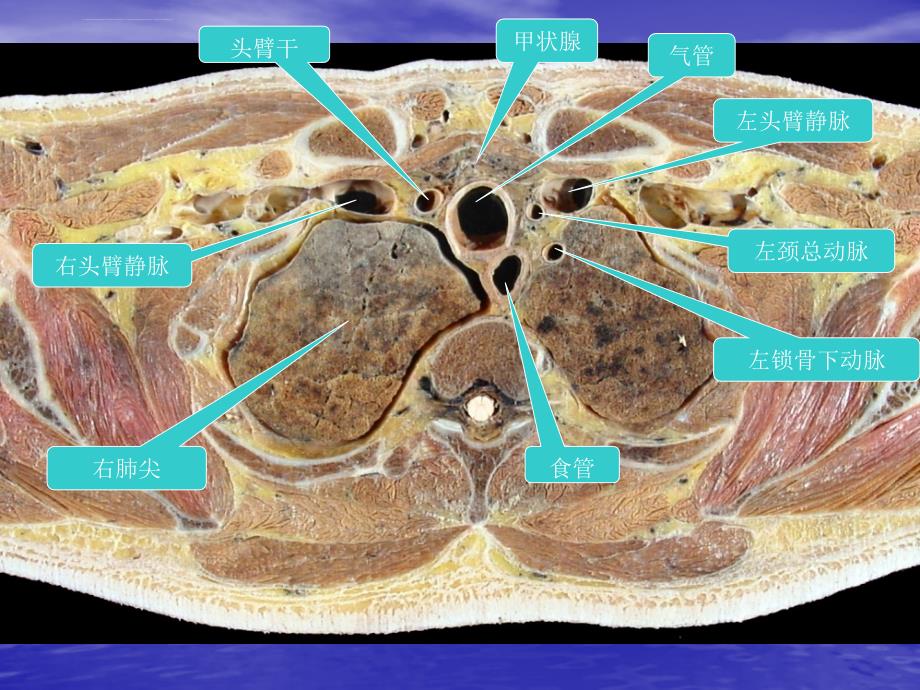 胸部的横断层解剖ppt幻灯片_第3页