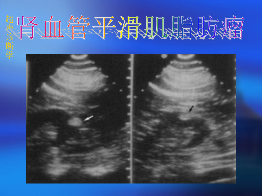 超声诊断学092肾炎结石外伤肿瘤ppt文档_第2页