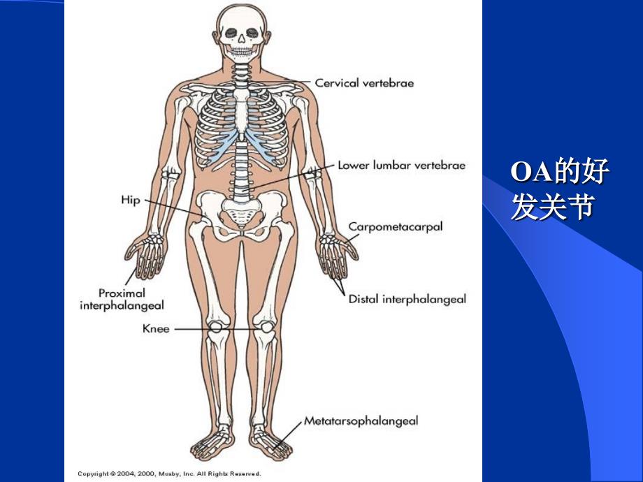 骨关节炎ppt详解_第4页