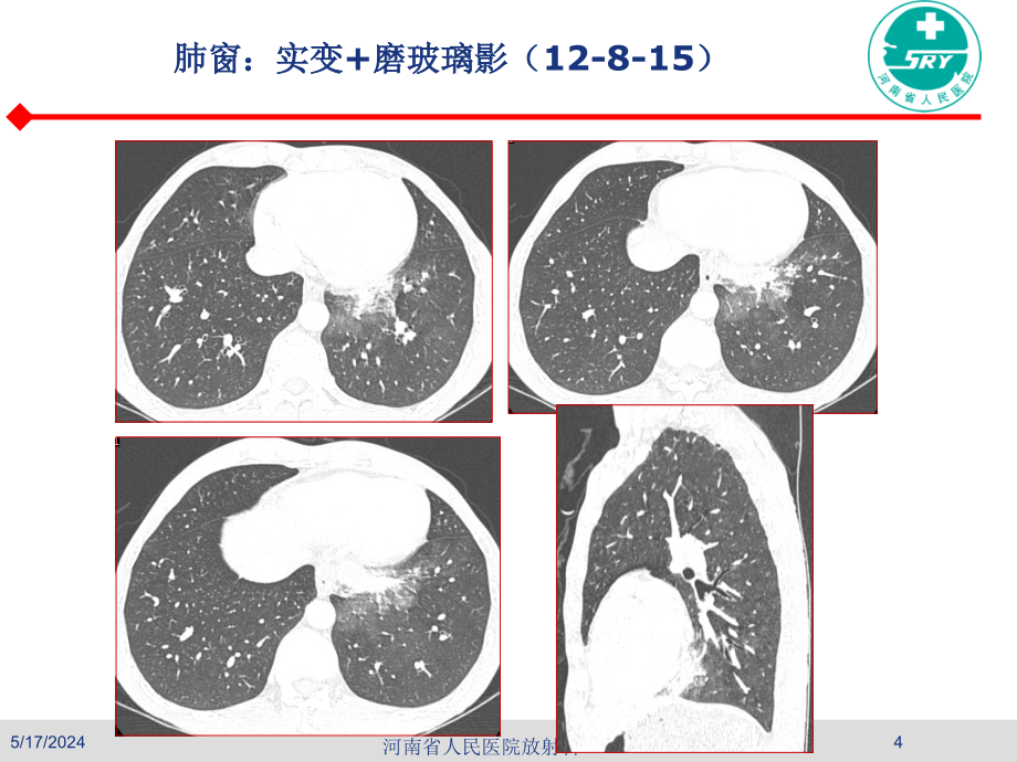 曲霉菌病的诊断ppt课件_第4页