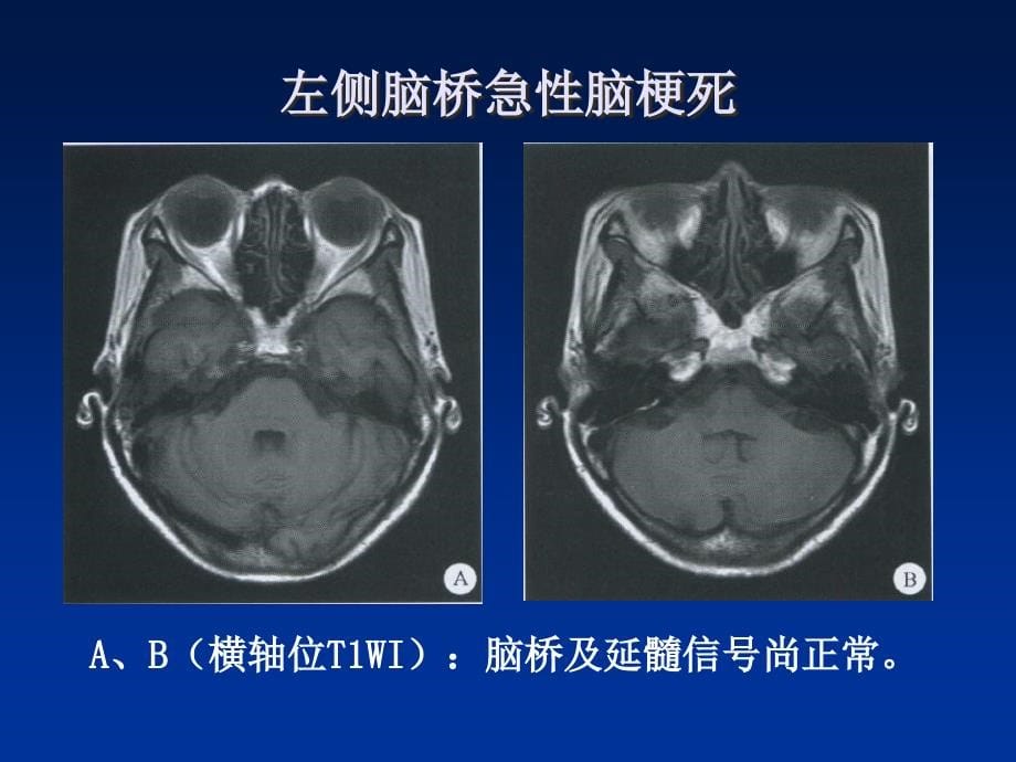 课件：神经内科ct和mri影像(1)_第5页