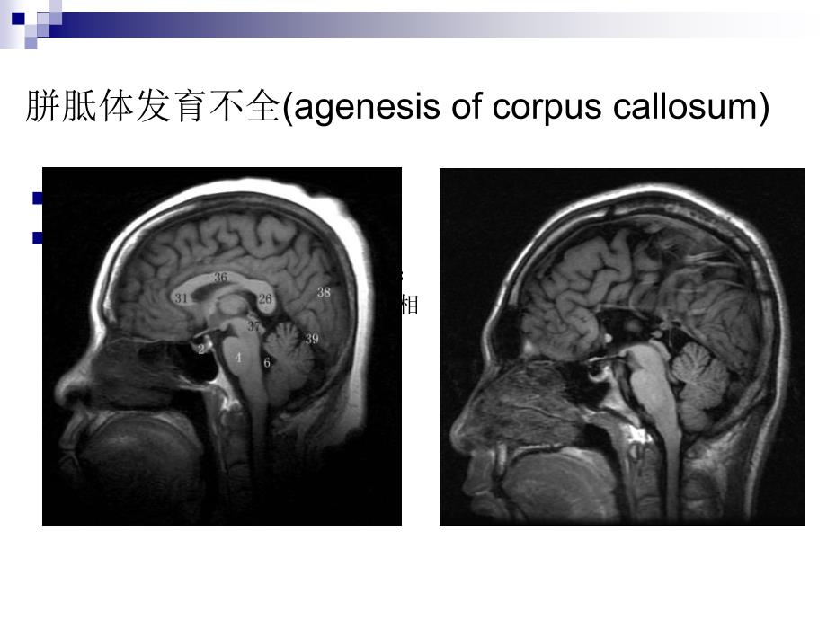 课件：神经系统常见疾病ct和mri_第4页