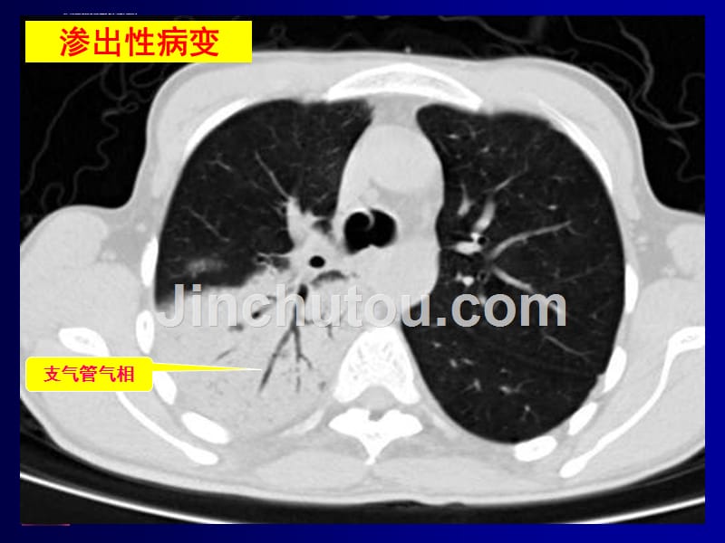 呼吸系统影像诊断(二)-基本病变-教学课件-幻灯_第4页