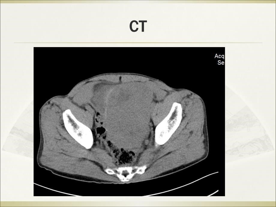 腹膜后恶性间质瘤影像诊断-课件_第5页