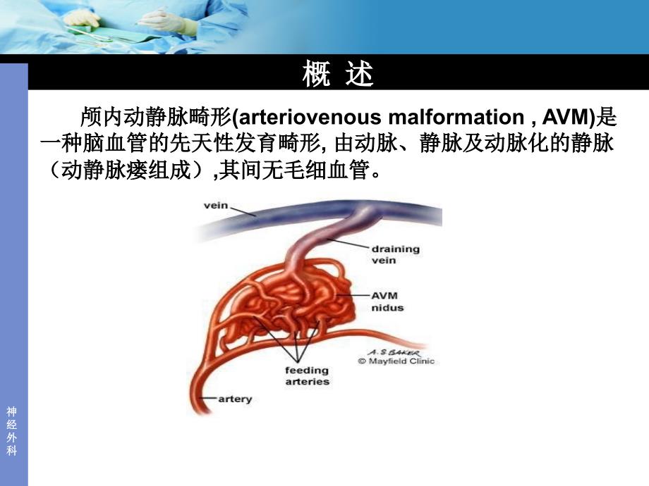 动静脉畸形AVM_第2页