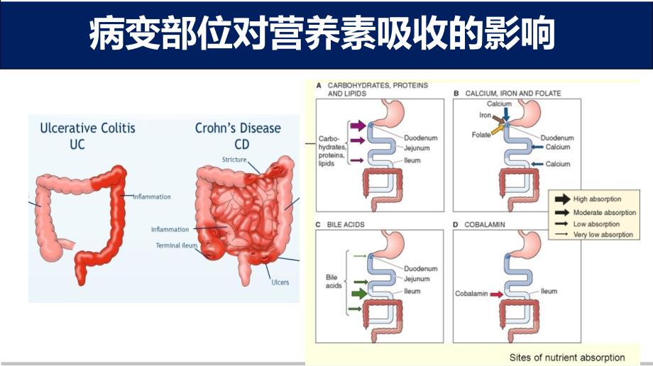 IBD的营养管理_第4页