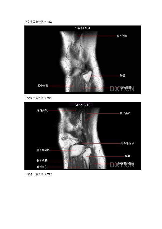 膝关节正常MRI解剖图谱(resonance关节MRI解剖之一)