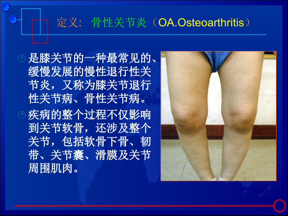 膝关节骨性关节炎诊治课件PPT91130_第2页