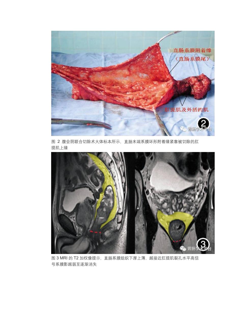 池畔全直肠系膜切除术(TME)中直肠系膜分离终点线的发现和解剖及其临床意义.pdf_第3页