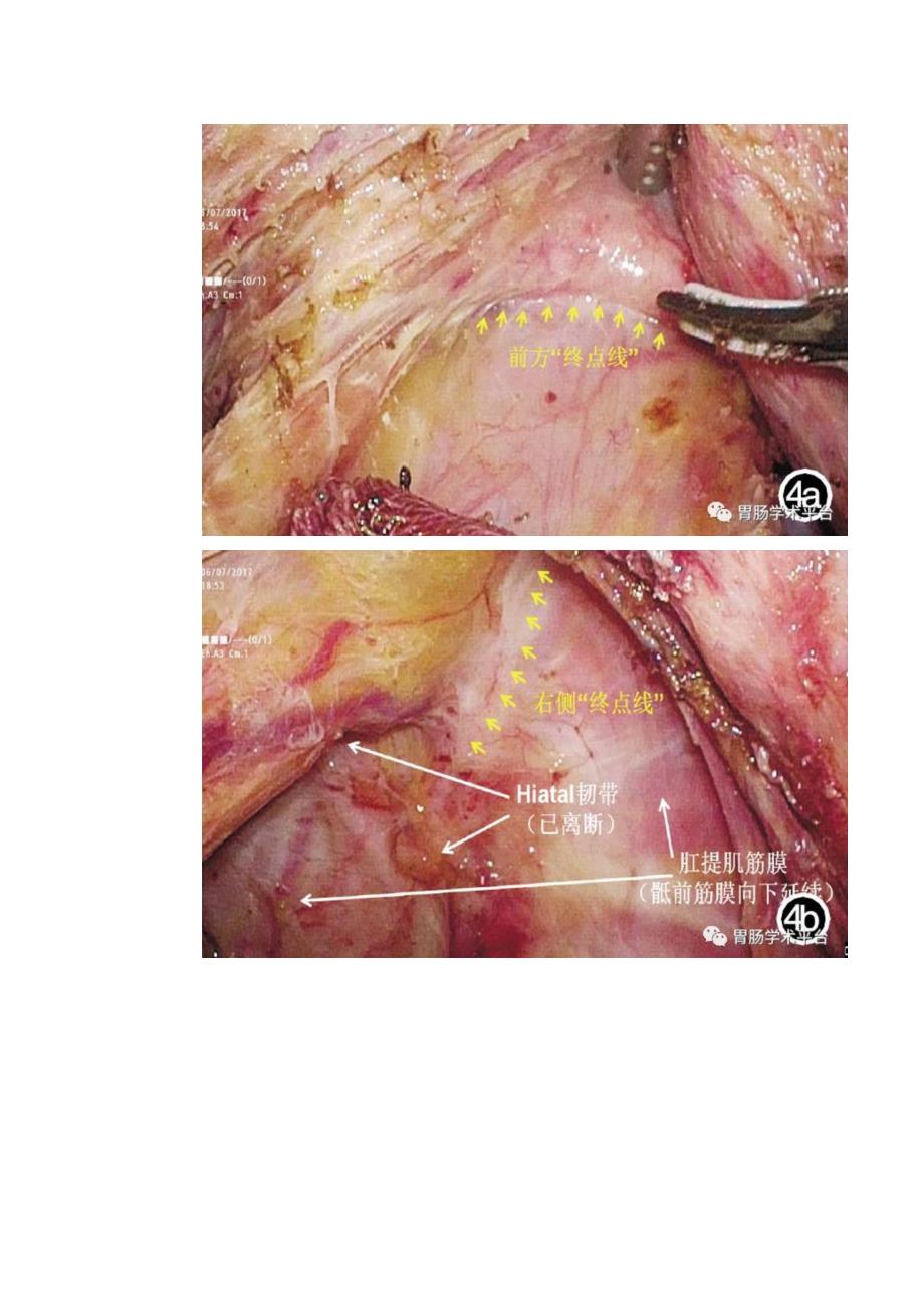 池畔全直肠系膜切除术(TME)中直肠系膜分离终点线的发现和解剖及其临床意义.pdf_第4页