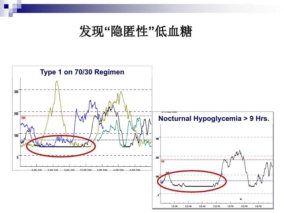 CGMS动态血糖监测图的临床意义与分析方法_第5页