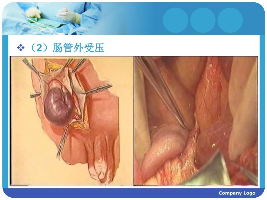 肠梗阻护理业务学t(课件_第4页