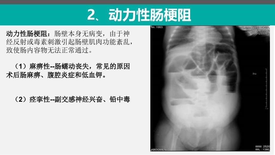 肠梗阻--马明标准幻灯片课件-ppt文档_第5页