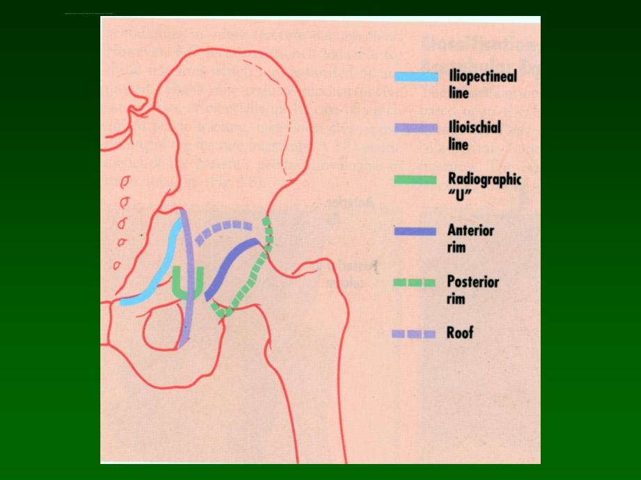 骨盆骨折(九院)课件_第4页