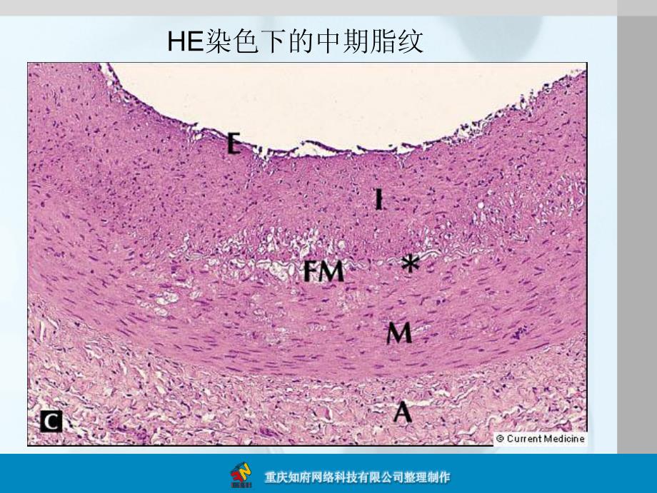 动脉粥样硬化病理图谱_第2页