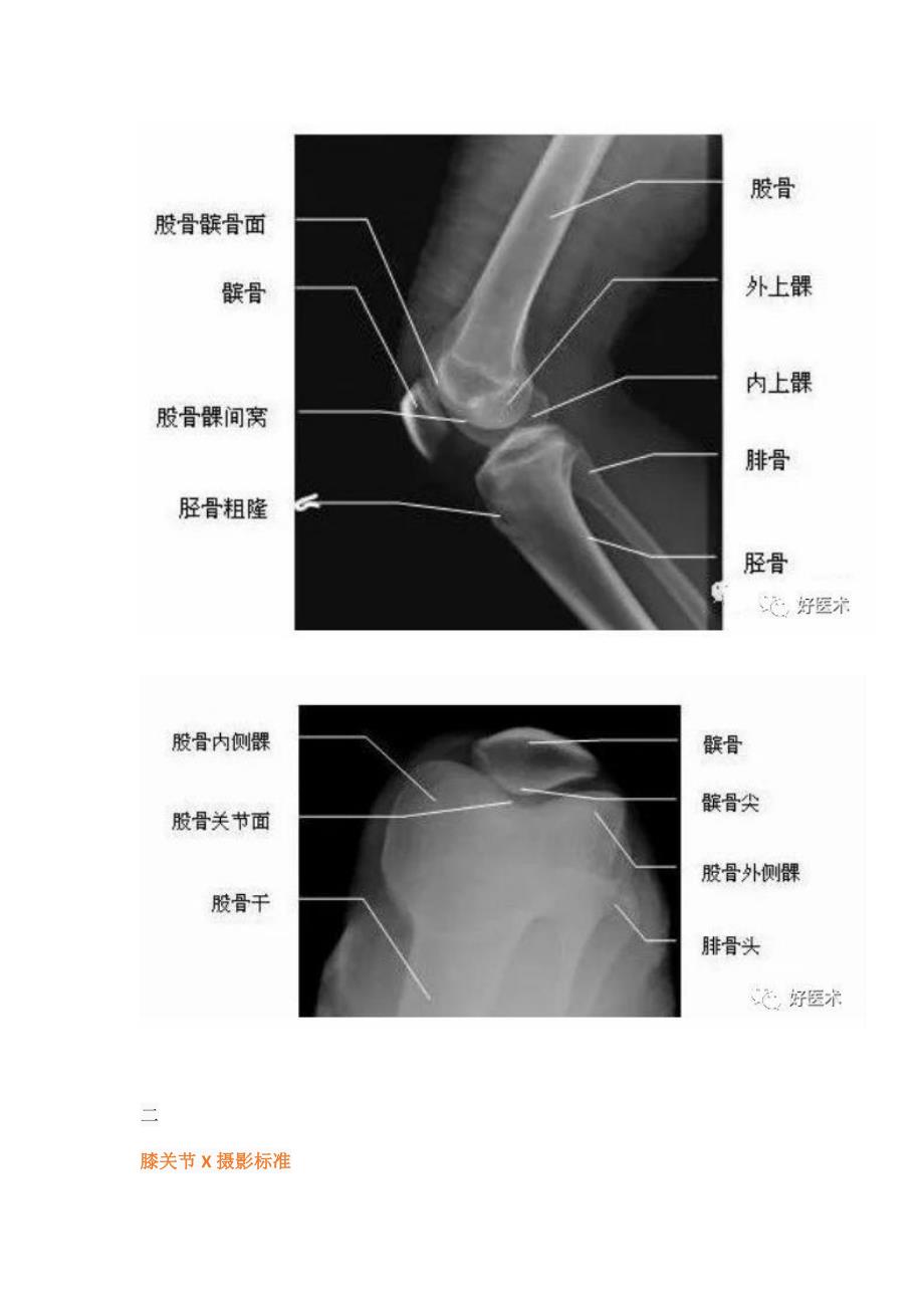 超详细的膝关节x线解剖及测量_第2页