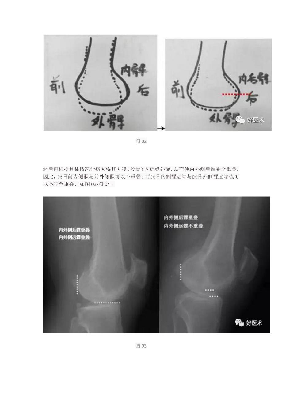 超详细的膝关节x线解剖及测量_第4页