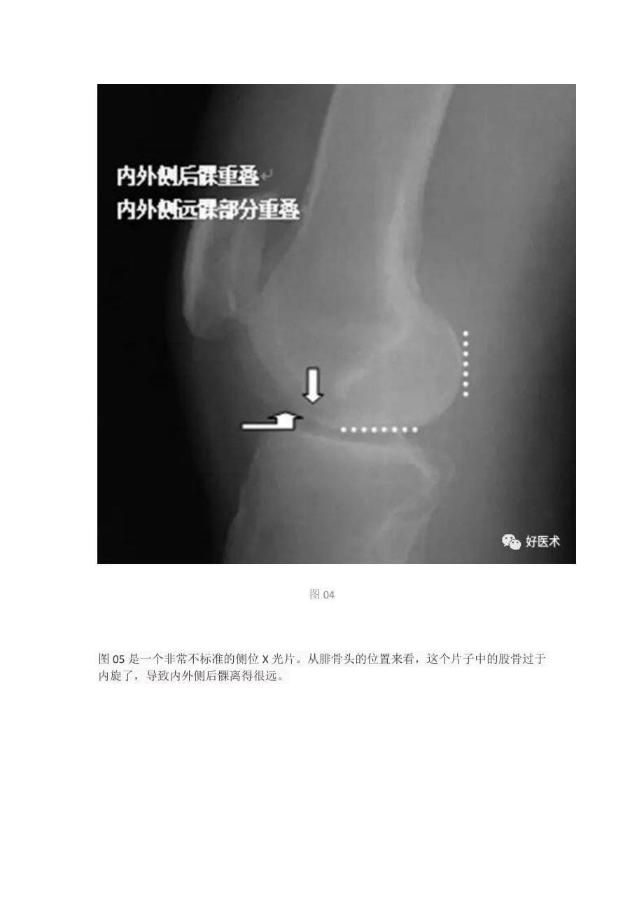 超详细的膝关节x线解剖及测量_第5页