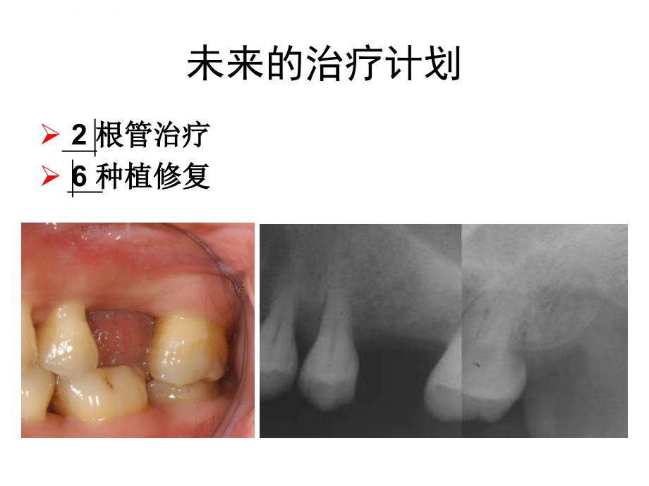 牙周基础治疗的临床病例介绍3课件_第2页