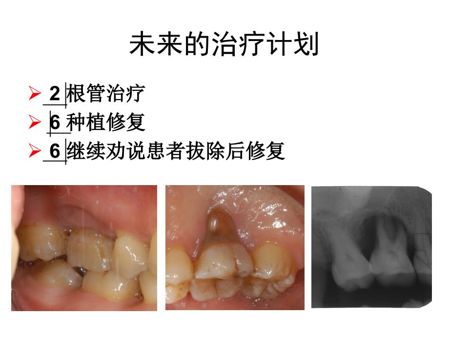 牙周基础治疗的临床病例介绍3课件_第3页