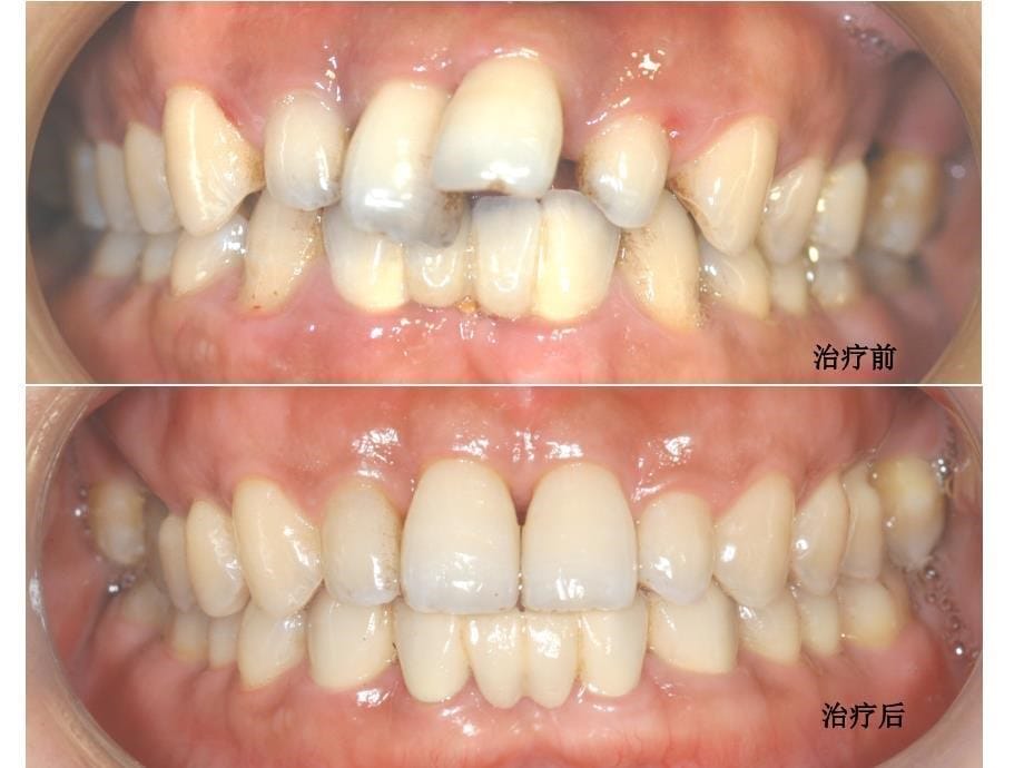 牙周基础治疗的临床病例介绍3课件_第5页