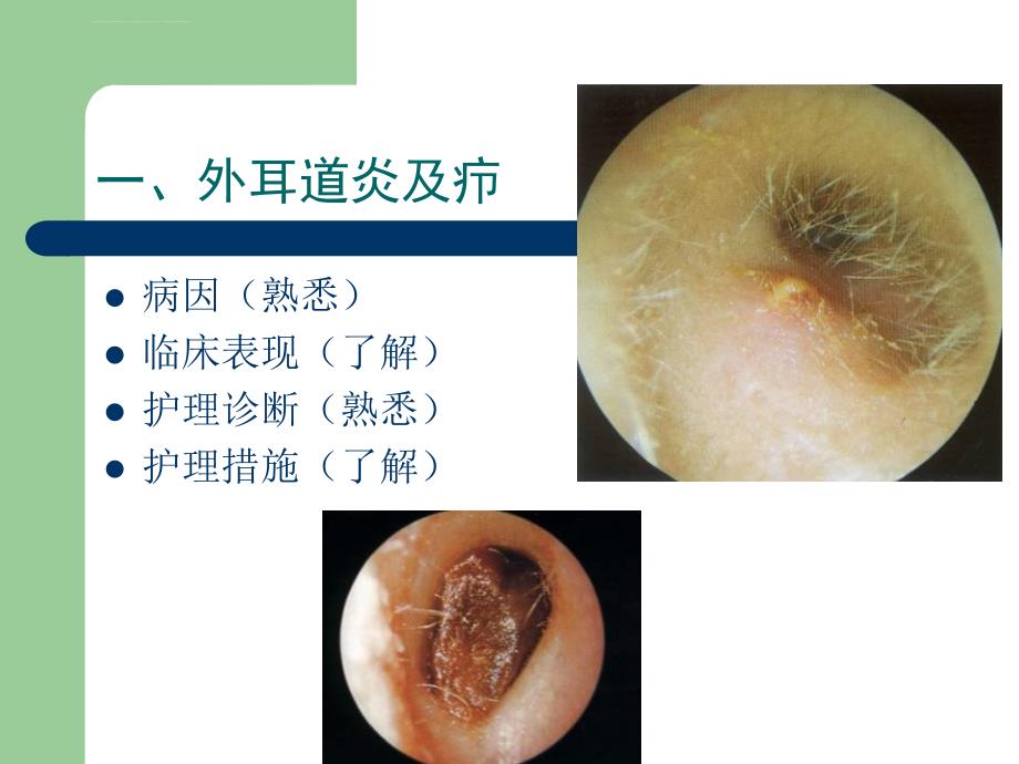 耳科病人的护理课件_第3页