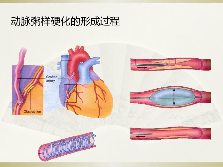 吃出来的奇迹动脉硬化的防治课件_第5页