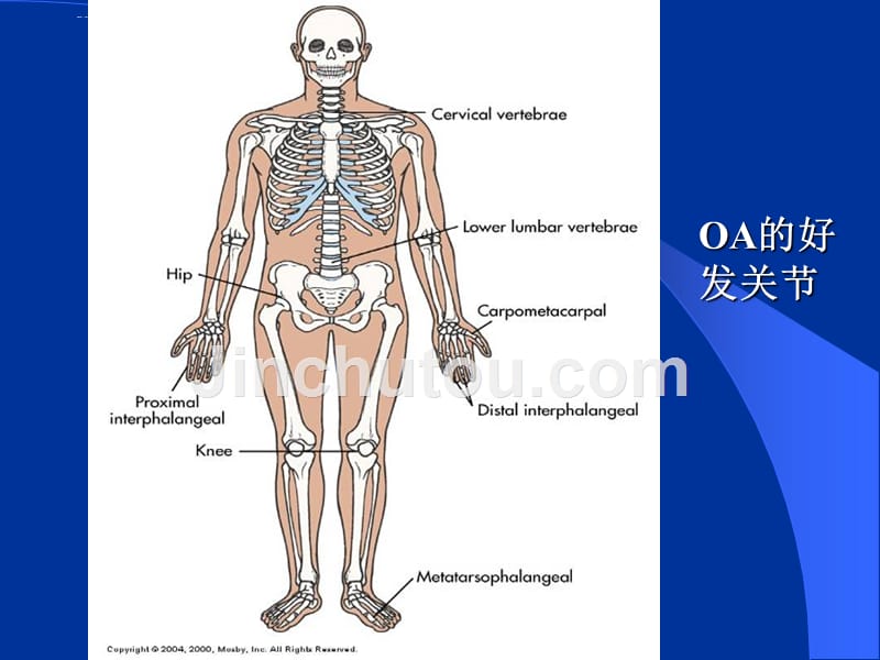 骨关节炎ppt详解课件_第4页