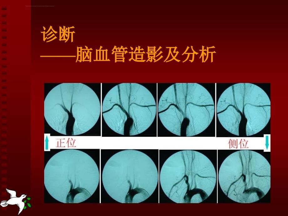 血管内介入技术在缺血性脑血管病诊治中的应用幻灯片_第5页