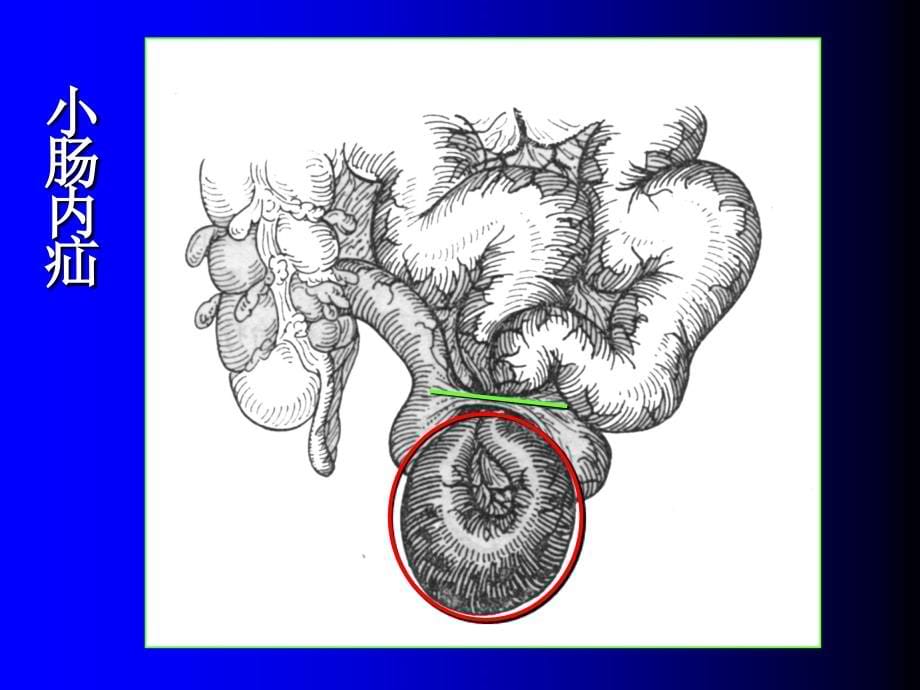 腹外疝和腹膜炎护理(本科)讲诉课件_第5页