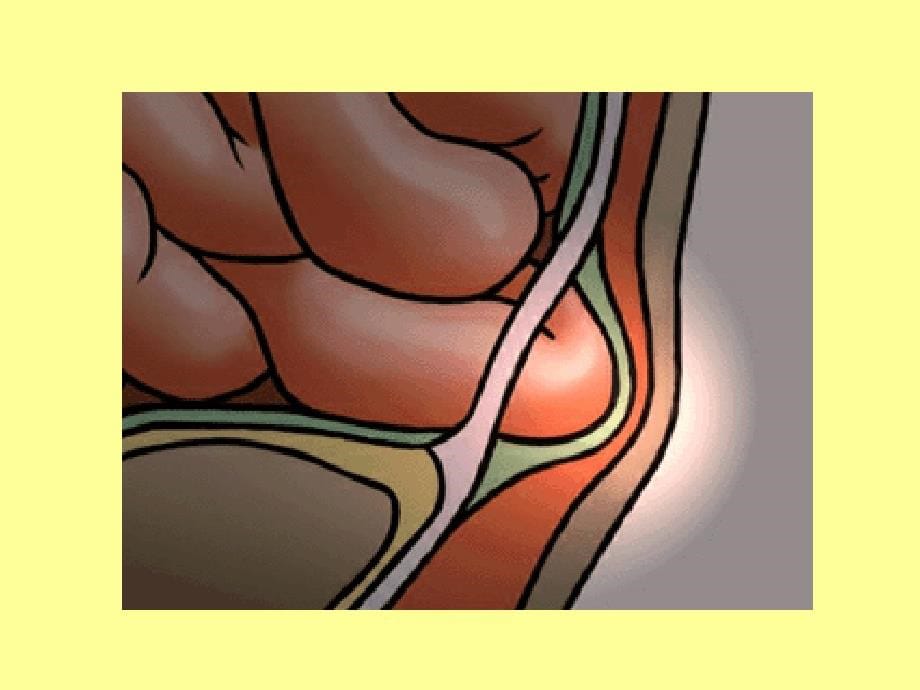 腹外疝病人的护理讲义课件_第5页