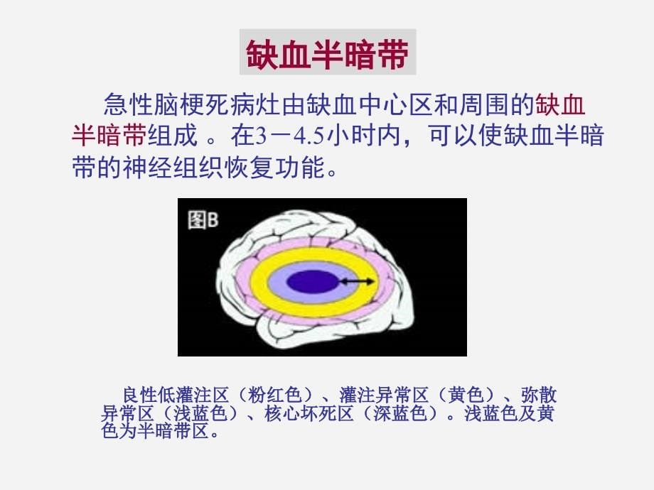 神经病学精品幻灯片(中山大学)4-脑血管病_第5页