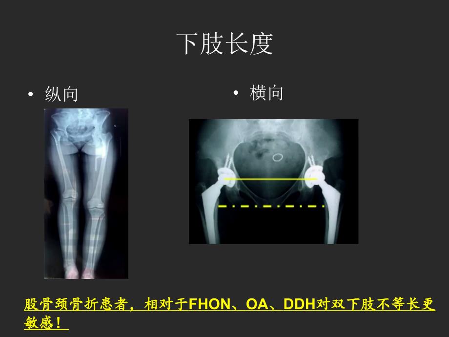 tha offset重建与下肢长度   吴海山_第3页