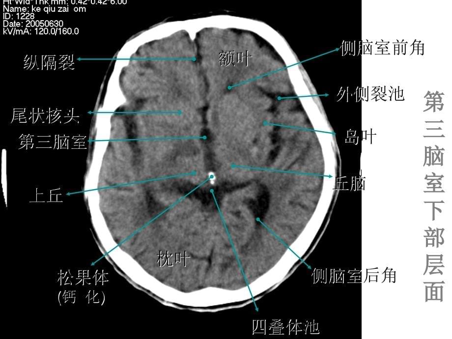 颅脑常见疾病CT诊断66566_第5页